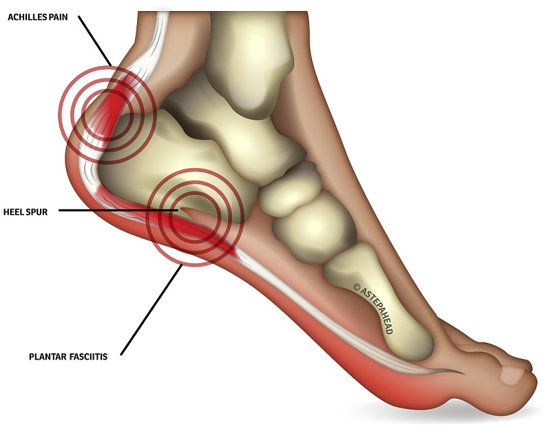 bottom heel pain causes